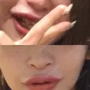 隆鼻術 / 鼻中隔延長（切開） 牧野皮膚科形成外科内科医院 美容外科・形成外科・抗加齢医学外来 DAY 274 サムネイル用