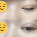 二重埋没 / 眼瞼下垂（切開） アリナガ美容外科 DAY 10 サムネイル用