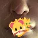 隆鼻術 / 鼻中隔延長（切開） 牧野皮膚科形成外科内科医院 美容外科・形成外科・抗加齢医学外来 DAY 173 サムネイル用