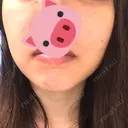 ほくろ・いぼ切除（肌） / YAGレーザー ラコスタ辻堂スキンクリニック AFTER サムネイル用