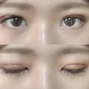 二重埋没 / 眼瞼下垂（切開） アリナガ美容外科 DAY 12 サムネイル用