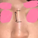 ヒアルロン酸注入（鼻） 神田美容外科形成外科医院 DAY 0 サムネイル用