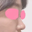 ヒアルロン酸注入（鼻） 神田美容外科形成外科医院 DAY 0 サムネイル用