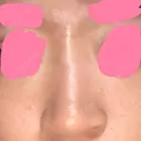 ヒアルロン酸注入（鼻） 神田美容外科形成外科医院 DAY 0 サムネイル用