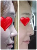 二重切開 / 目頭切開 / 眼瞼下垂（切開） / 隆鼻術 / 目尻切開 / 上まぶたたるみ取り / 軟骨移植 湘南美容クリニック 岡山院 DAY 38 サムネイル用