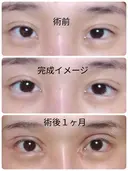 二重切開 / 目頭切開 / 眼瞼下垂（切開） / 隆鼻術 / 目尻切開 / 上まぶたたるみ取り / 軟骨移植 湘南美容クリニック 岡山院 DAY 38 サムネイル用
