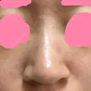 ヒアルロン酸注入（鼻） 神田美容外科形成外科医院 DAY 1 サムネイル用