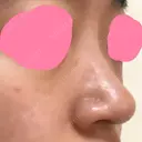 ヒアルロン酸注入（鼻） 神田美容外科形成外科医院 DAY 1 サムネイル用