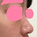 ヒアルロン酸注入（鼻） 神田美容外科形成外科医院 DAY 1 サムネイル用