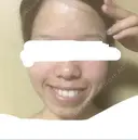 糸リフト / バッカルファット除去 / ボトックス（エラ・小顔） 湘南美容クリニック 静岡院 DAY 22 サムネイル用