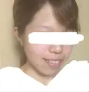 糸リフト / バッカルファット除去 / ボトックス（エラ・小顔） 湘南美容クリニック 静岡院 DAY 22 サムネイル用