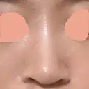 ヒアルロン酸注入（鼻） 神田美容外科形成外科医院 AFTER サムネイル用