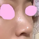 ヒアルロン酸注入（鼻） 神田美容外科形成外科医院 DAY 2 サムネイル用