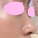 ヒアルロン酸注入（鼻） 神田美容外科形成外科医院 DAY 2 サムネイル用