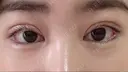 二重埋没 / 眼瞼下垂（切開） / 目尻切開 / 蒙古ひだ形成 / タレ目形成・グラマラスライン（切開） POP美容整形クリニック DAY 28 サムネイル用