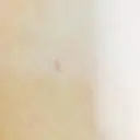 クマ治療 / 額を丸く / 脂肪吸引（脚） / レディエッセ注入（鼻） THE CLINIC（ザ・クリニック） 東京院 DAY 33 サムネイル用