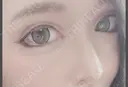 二重切開 / 目頭切開 / 眼瞼下垂（切開） / 隆鼻術 / 目尻切開 / 上まぶたたるみ取り / 軟骨移植 湘南美容クリニック 岡山院 DAY 41 サムネイル用