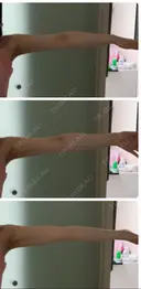 その他（ボディ） / 脂肪溶解注射（二の腕） / ハイフ（顔） クリム整形外科 DAY 43 サムネイル用