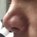 隆鼻術 / 鼻中隔延長（切開） 牧野皮膚科形成外科内科医院 美容外科・形成外科・抗加齢医学外来 DAY 277 サムネイル用