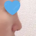 隆鼻術 / 鼻尖形成（切開） / 鼻中隔延長（切開） / 小鼻縮小（切開） / 骨切幅寄せ / ワシ鼻修正・ハンプ切除 / 鼻尖縮小 FROM B整形外科 (旧バウム整形外科) DAY 62 サムネイル用