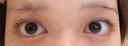 その他（目元） / 眉下切開 湘南美容クリニック 秋葉原院 DAY 12 サムネイル用