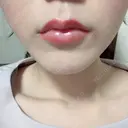 ヒアルロン酸注入（唇） / ボトックス（口角） フィラークリニック 恵比寿院 AFTER サムネイル用