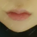 ボトックス（エラ・小顔） / 脂肪溶解注射（顔） / ヒアルロン酸注入（唇） / ボトックス（口角） the way（ザウェイ）整形外科 DAY 1 サムネイル用