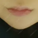 ボトックス（エラ・小顔） / 脂肪溶解注射（顔） / ヒアルロン酸注入（唇） / ボトックス（口角） the way（ザウェイ）整形外科 DAY 1 サムネイル用