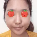 目頭切開 / バッカルファット除去 / 脂肪吸引（顔） / 目尻切開 / タレ目形成・グラマラスライン（切開） / その他（目元） RG整形外科（旧リオン整形外科） DAY 20 サムネイル用