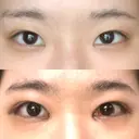 目頭切開 / バッカルファット除去 / 脂肪吸引（顔） / 目尻切開 / タレ目形成・グラマラスライン（切開） / その他（目元） RG整形外科（旧リオン整形外科） DAY 20 サムネイル用