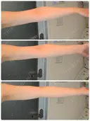 その他（ボディ） / 脂肪溶解注射（二の腕） / ハイフ（顔） クリム整形外科 DAY 47 サムネイル用