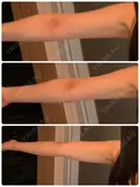 その他（ボディ） / 脂肪溶解注射（二の腕） / ハイフ（顔） クリム整形外科 DAY 47 サムネイル用