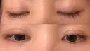 二重埋没 / 目頭切開 / 眼瞼下垂（切開） / 目尻切開 グロービー美容整形外科 DAY 76 サムネイル用