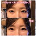 クマ治療 / 下まぶたたるみ取り / 下まぶたの脂肪取り セオリークリニック DAY 14 サムネイル用