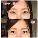 クマ治療 / 下まぶたたるみ取り / 下まぶたの脂肪取り セオリークリニック DAY 14 サムネイル用