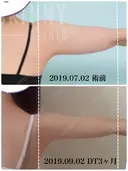 脂肪溶解注射（二の腕） / ボトックス（肩） / その他（ボディ） THE SKINNY CLINIC（ザ・スキニークリニック） DAY 62 サムネイル用