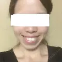 糸リフト / バッカルファット除去 / ボトックス（エラ・小顔） 湘南美容クリニック 静岡院 DAY 33 サムネイル用