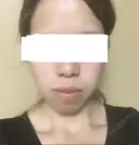 糸リフト / バッカルファット除去 / ボトックス（エラ・小顔） 湘南美容クリニック 静岡院 DAY 33 サムネイル用