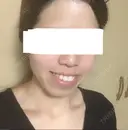 糸リフト / バッカルファット除去 / ボトックス（エラ・小顔） 湘南美容クリニック 静岡院 DAY 33 サムネイル用
