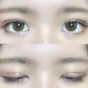 二重埋没 / 眼瞼下垂（切開） アリナガ美容外科 DAY 27 サムネイル用