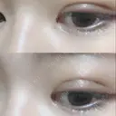 二重埋没 / 眼瞼下垂（切開） アリナガ美容外科 DAY 27 サムネイル用
