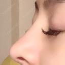 隆鼻術 / 鼻尖形成（切開） / 鼻中隔延長（切開） / 軟骨移植 / プロテーゼ除去 / 鼻修正 湘南美容クリニック 新宿本院 DAY 183 サムネイル用
