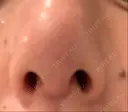 鼻尖形成（切開） / 骨切幅寄せ / ワシ鼻修正・ハンプ切除 FROM B整形外科 (旧バウム整形外科) DAY 13 サムネイル用