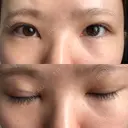二重埋没 / 下まぶたの脂肪取り / ボトックス（エラ・小顔） 表参道スキンクリニック 表参道院 DAY 5 サムネイル用