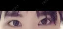 二重切開 / 目頭切開 / 眼瞼下垂（切開） / 目尻切開 ジュエリー美容外科 DAY 19 サムネイル用