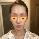 小鼻縮小（切開） / 糸リフト / 鼻尖縮小 / ヒアルロン酸注入（鼻） / ハイフ（顔） ヴェリテクリニック 大阪院 DAY 119 サムネイル用