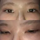 二重埋没 / 下まぶたの脂肪取り / ボトックス（エラ・小顔） 表参道スキンクリニック 表参道院 DAY 6 サムネイル用