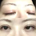 眼瞼下垂（切開） 札幌中央形成外科 DAY 17 サムネイル用