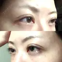 眼瞼下垂（切開） 札幌中央形成外科 DAY 17 サムネイル用