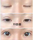 二重埋没 城本クリニック 姫路院 DAY 11 サムネイル用